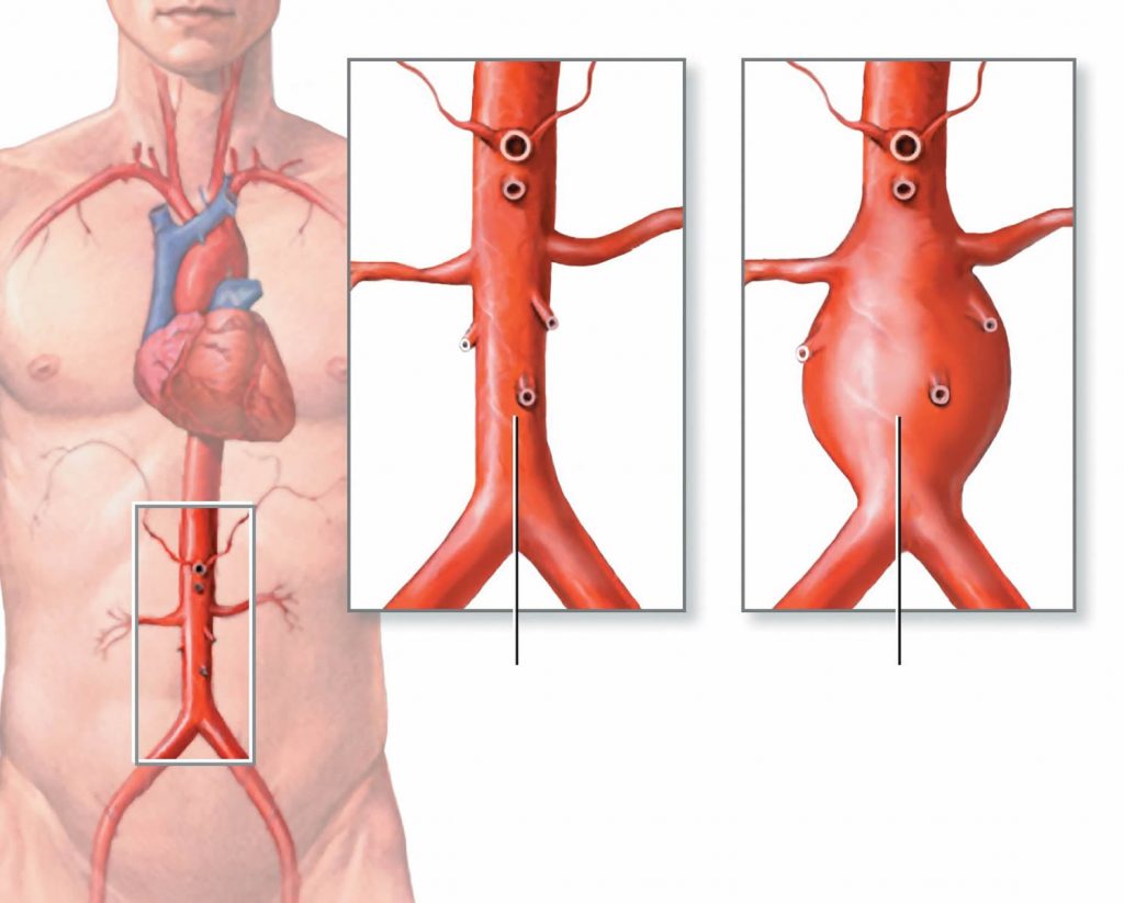 Aneurisma de aorta abdominal: síntomas y factores de riesgo
